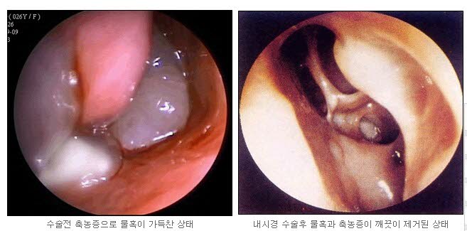 축농증3.jpg