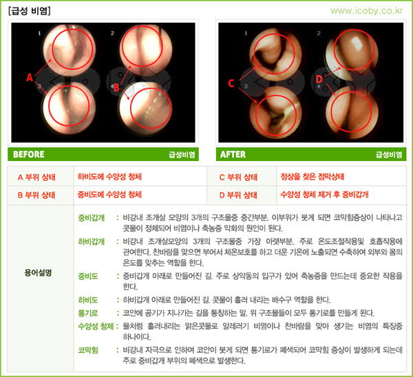 급성비염코비.jpg