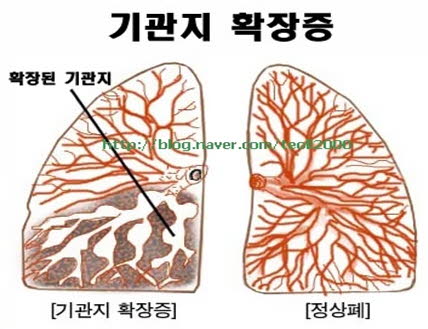 기관지확장증_01.jpg