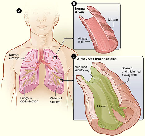 Bronchiectasis_NHLBI.jpg