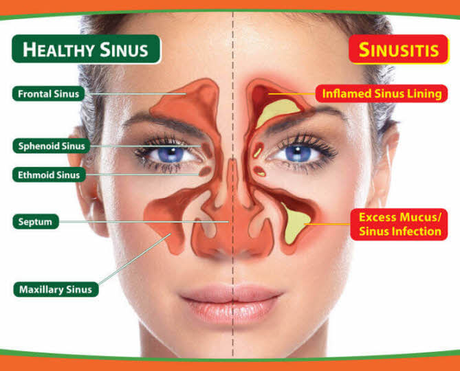 sinusitis-symptoms.jpg