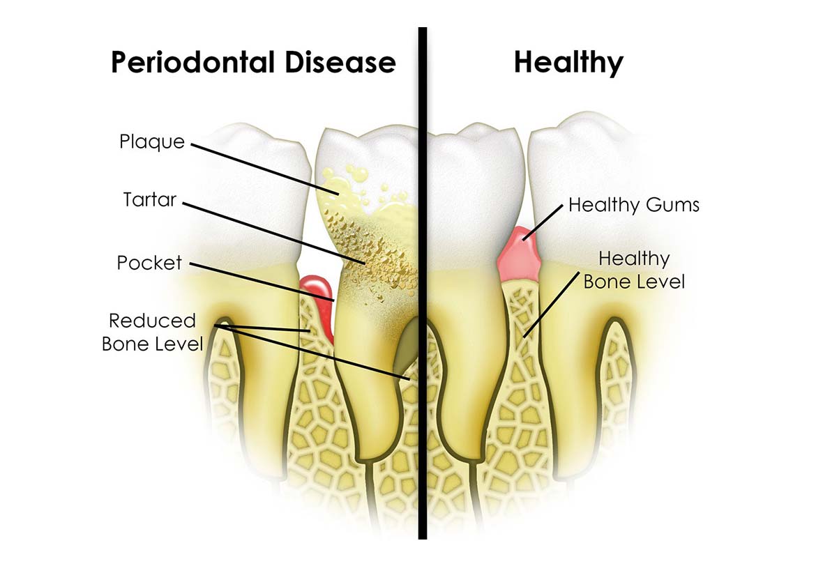 Kansas-City-Plaza-Periodontal-Disease.jpg