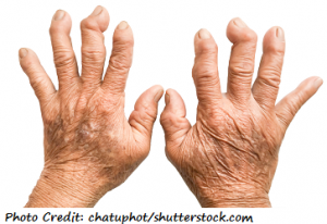 rheumatoid-arthritis-in-the-hands-fingers-300x206.png