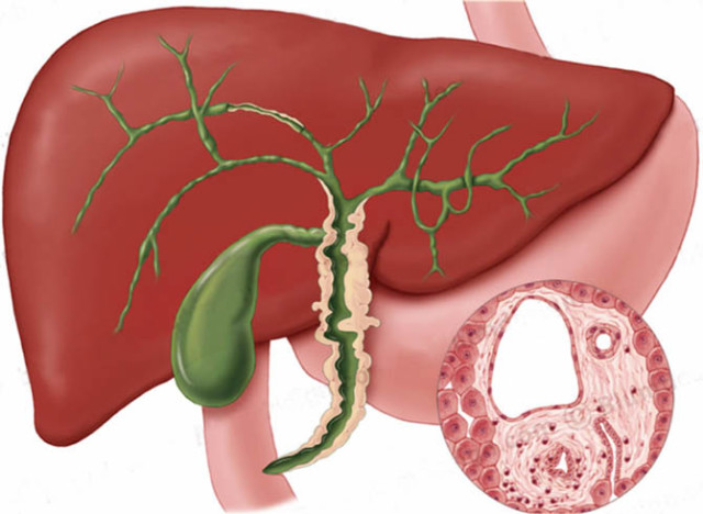 non-alcoholic-fatty-liver-disease-e1383407172146.jpg