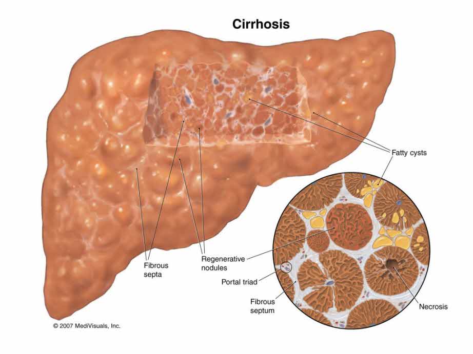 Liver-Cirrhosis-1024x768.jpg