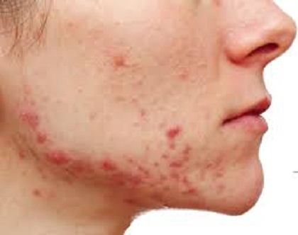 acne rosacea.jpg